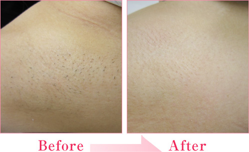 レーザー脱毛（ワキ）