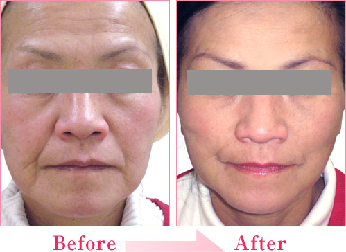 ミラクルリフト