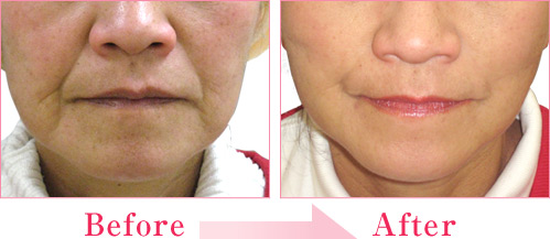 ミラクルリフト