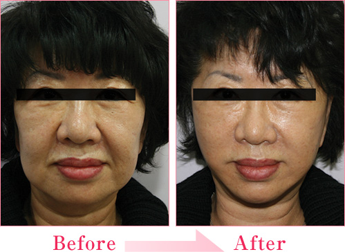 ミラクルリフト