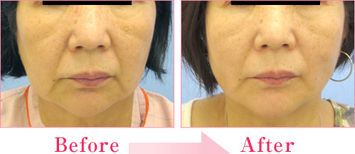 ミラクルリフト