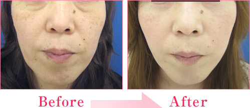 ミラクルリフト