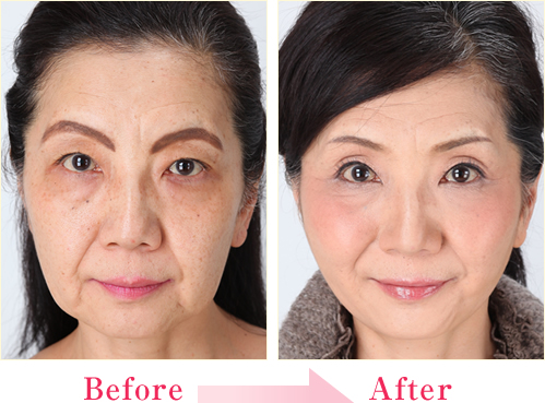 ミラクルリフト