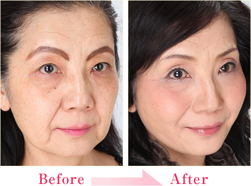 ミラクルリフト