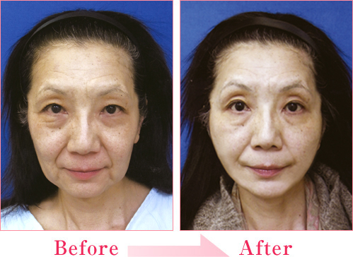 ミラクルリフト