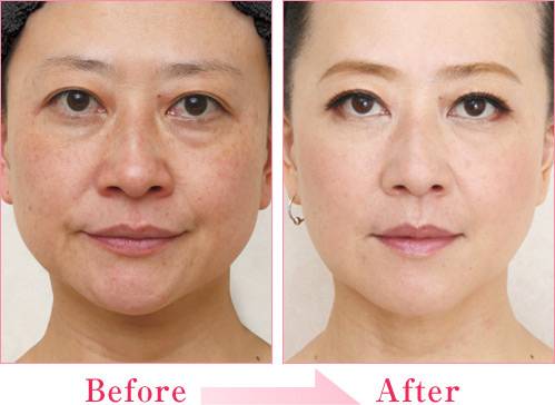 ミラクルリフト