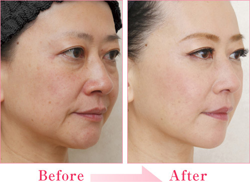 ミラクルリフト