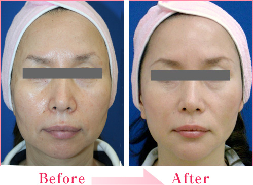 シルエットリフト