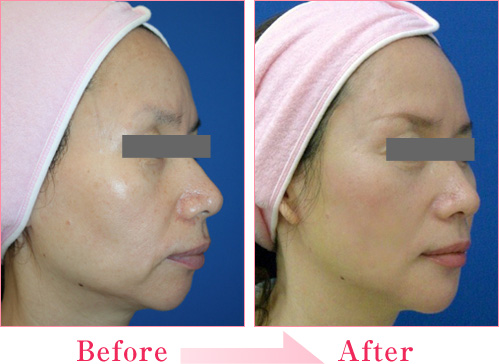 シルエットリフト