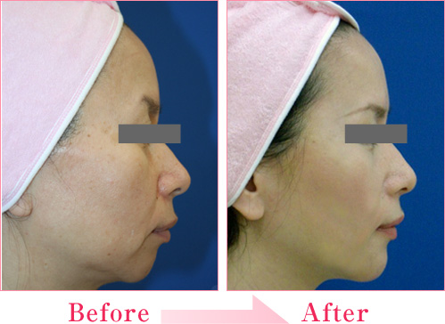 シルエットリフト