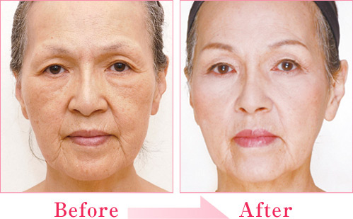 シルエットリフト